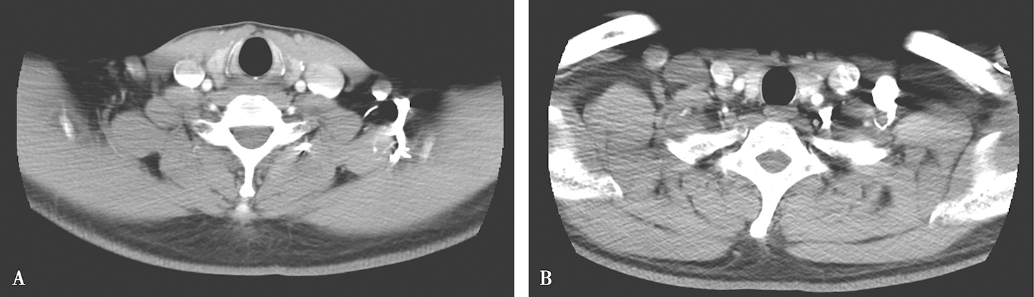 图2 颈部增强CT.jpg